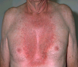 Rash on Genitals: Causes, Treatments, and Prognosis