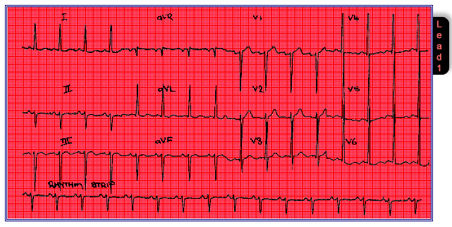 EKG Quizzer 1: Basic EKG Features